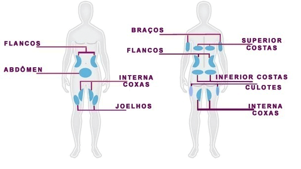 Zonas de Tratamento Criolipólise em Lisboa